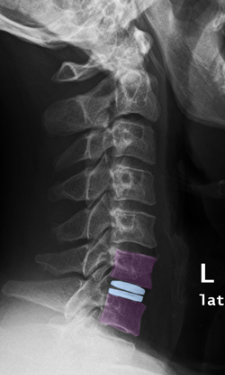 Cervicalarthro3