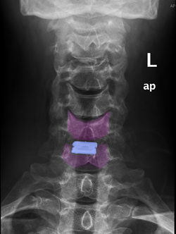 Cervicalarthro4