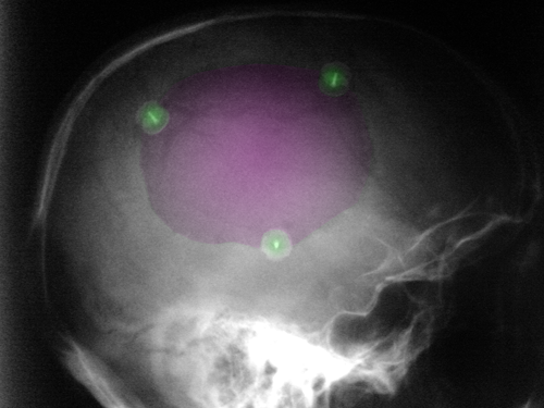 Cranioplasty