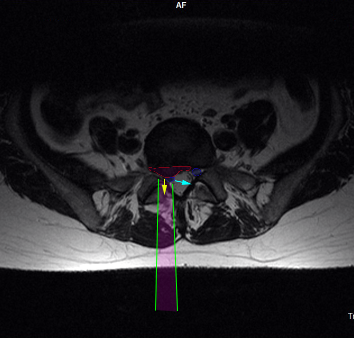 LumbarDiscectomy