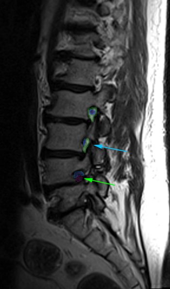 ForamenStenosis