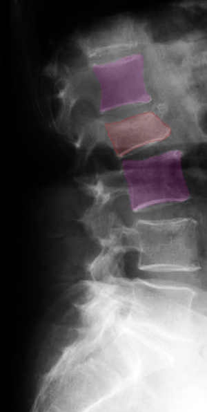 Cyphoplasty