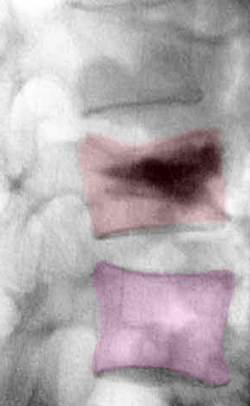 Cyphoplasty3